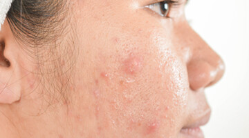 Acne Scarring | Skindoc Dermatologists | Liverpool Sydney | Dr Jennifer Yip