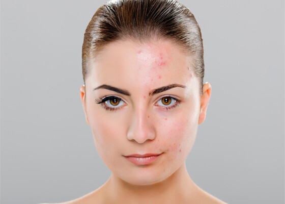 Acne | Skindoc Dermatologists | Liverpool Sydney | Dr Jennifer Yip