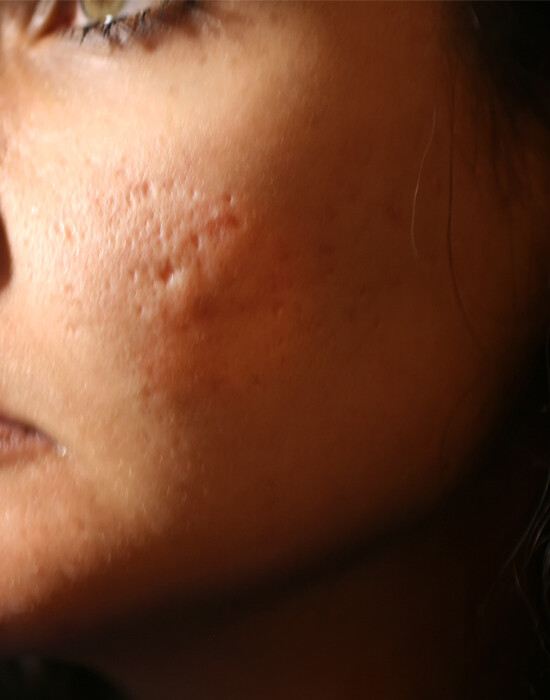 Acne | Skindoc Dermatologists | Liverpool Sydney | Dr Jennifer Yip