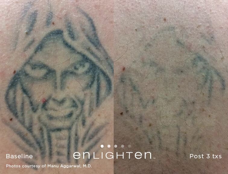 Tattoo removal -this last... - Pure Skin Aesthetics Clinic | Facebook