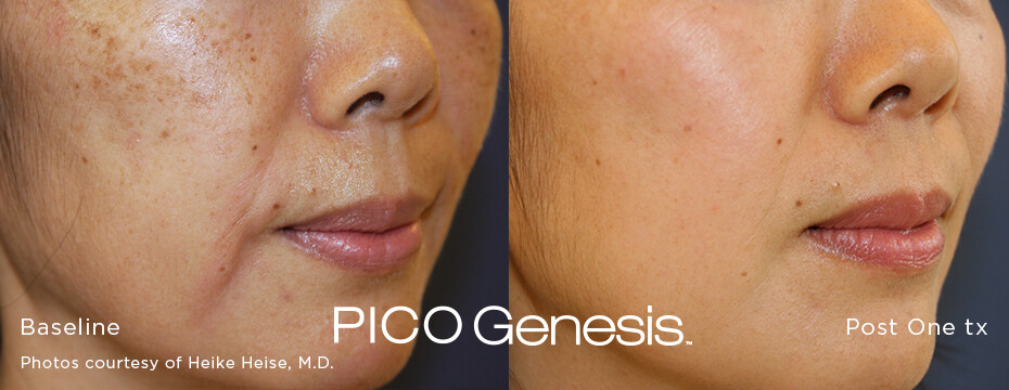 PICO Laser for Pigmentation | Skindoc Dermatologists | Liverpool Sydney | Dr Jennifer Yip