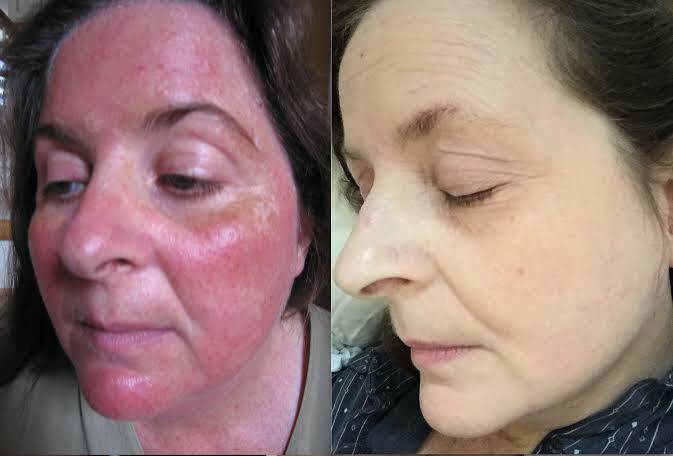 Rosacea - Skindoc | Dr Jennifer Yip | Dermatologist | Sydney